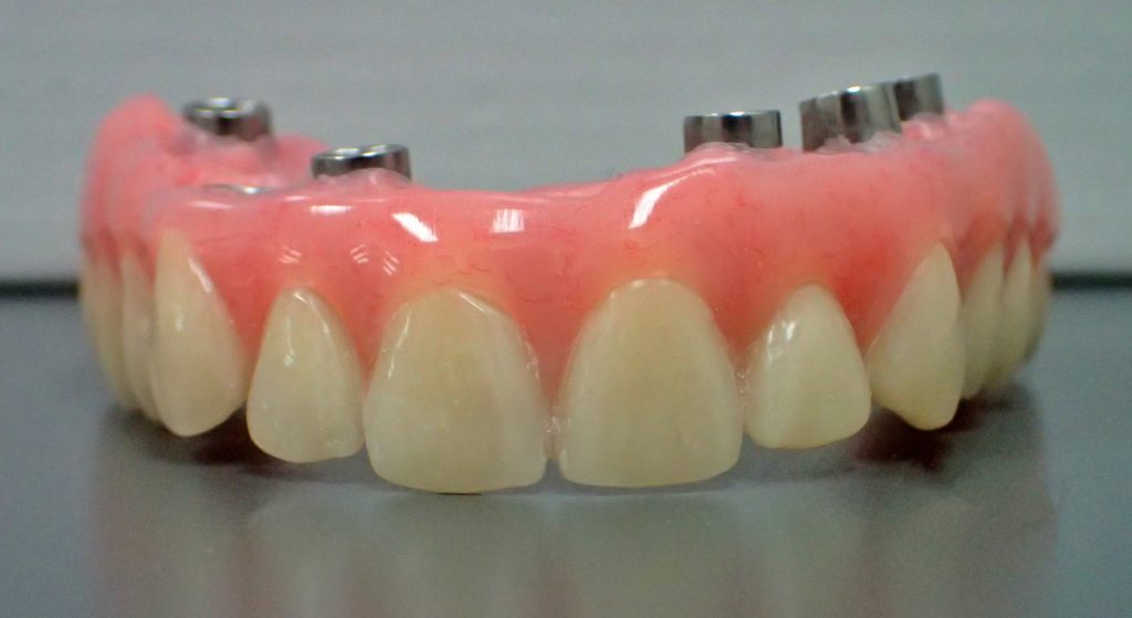 Fixed Implant Retained Hybrid Dentures Burnham Denture Clinic in